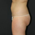 Jersey Shore Butt Lift Case 6748, Before Treatment, Female Patient, Thumbnail 2