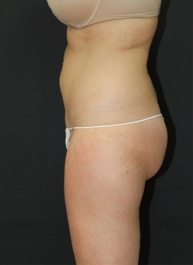 Jersey Shore Butt Lift Case 6748, Before Treatment, Female Patient, Set 2