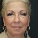 Face and Neck Rejuvenation Case 6491, After Treatment, Female Patient, Thumbnail 1
