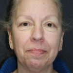 Face and Neck Rejuvenation Case 6491, Before Treatment, Female Patient, Thumbnail 1