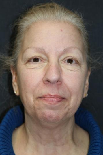 Neck Lift Before Photo