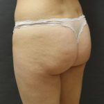 Jersey Shore Butt Lift Case 6749, Before Treatment, Female Patient, Thumbnail 2