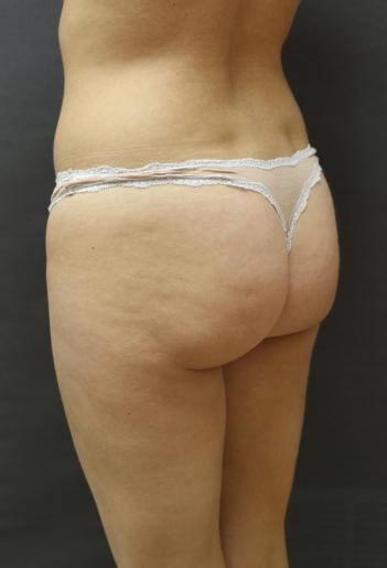 Jersey Shore Butt Lift Case 6749, Before Treatment, Female Patient, Set 2