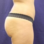 Jersey Shore Butt Lift Case 6749, After Treatment, Female Patient, Thumbnail 1