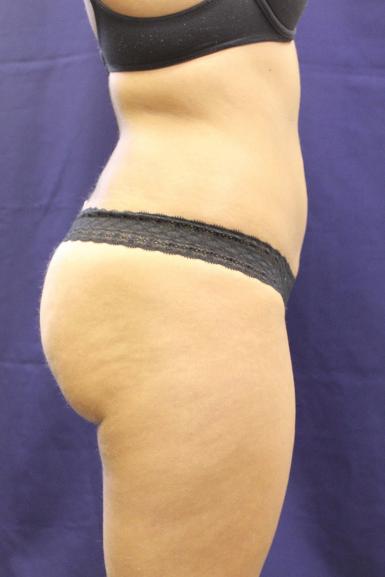 Thigh Lift After Photo