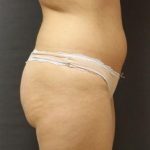 Jersey Shore Butt Lift Case 6749, Before Treatment, Female Patient, Thumbnail 1