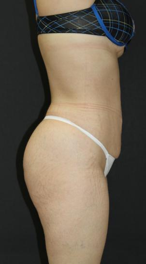 Jersey Shore Butt Lift Case 6750, After Treatment, Female Patient, Set 2