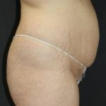 Jersey Shore Butt Lift Case 6750, Before Treatment, Female Patient, Thumbnail 2