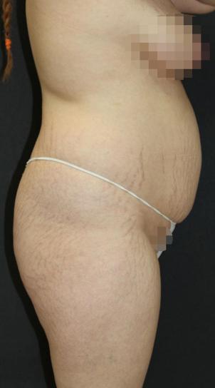 Jersey Shore Butt Lift Case 6750, Before Treatment, Female Patient, Set 2