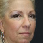 Face and Neck Rejuvenation Case 6491, After Treatment, Female Patient, Thumbnail 3