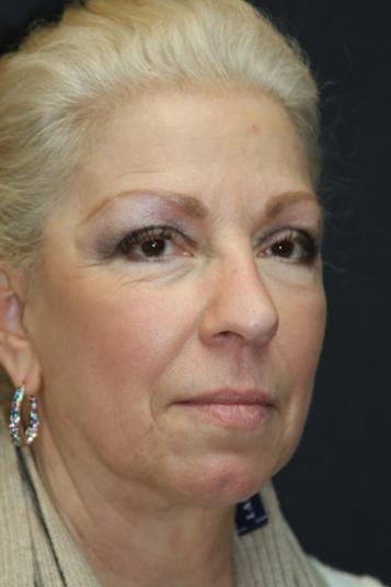 Face and Neck Rejuvenation Case 6491, After Treatment, Female Patient, Set 3