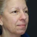 Face and Neck Rejuvenation Case 6491, Before Treatment, Female Patient, Thumbnail 3