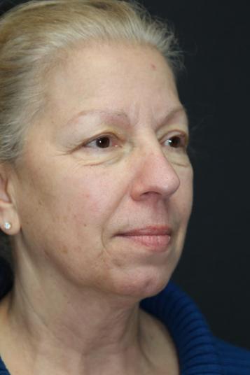 Face and Neck Rejuvenation Case 6491, Before Treatment, Female Patient, Set 3