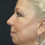 Face and Neck Rejuvenation Case 6491, After Treatment, Female Patient, Thumbnail 4
