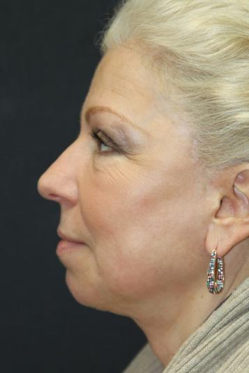 Face and Neck Rejuvenation Case 6491, After Treatment, Female Patient, Set 4