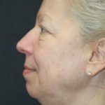 Face and Neck Rejuvenation Case 6491, Before Treatment, Female Patient, Thumbnail 4