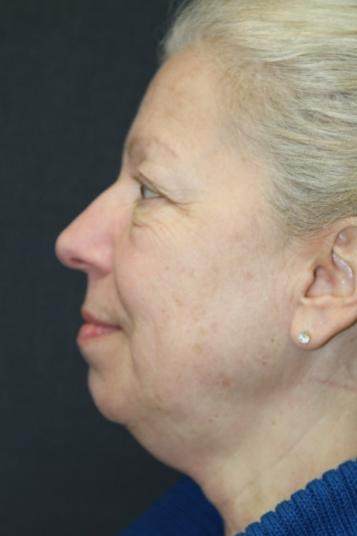 Face and Neck Rejuvenation Case 6491, Before Treatment, Female Patient, Set 4