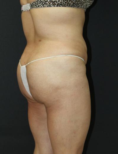 Jersey Shore Butt Lift Case 6751, After Treatment, Female Patient, Set 2