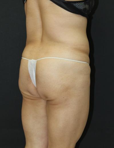 Jersey Shore Butt Lift Case 6751, Before Treatment, Female Patient, Set 2