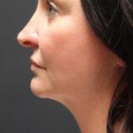 Face and Neck Rejuvenation Case 6753, After Treatment, Female Patient, Thumbnail 1