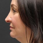Face and Neck Rejuvenation Case 6753, Before Treatment, Female Patient, Thumbnail 1