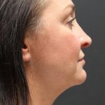Face and Neck Rejuvenation Case 6753, After Treatment, Female Patient, Thumbnail 2