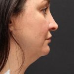 Face and Neck Rejuvenation Case 6753, Before Treatment, Female Patient, Thumbnail 2