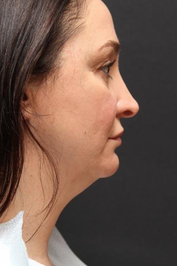 Face and Neck Rejuvenation Case 6753, Before Treatment, Female Patient, Set 2