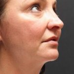 Face and Neck Rejuvenation Case 6753, After Treatment, Female Patient, Thumbnail 3