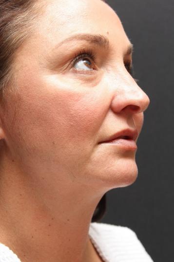 Face and Neck Rejuvenation Case 6753, After Treatment, Female Patient, Set 3