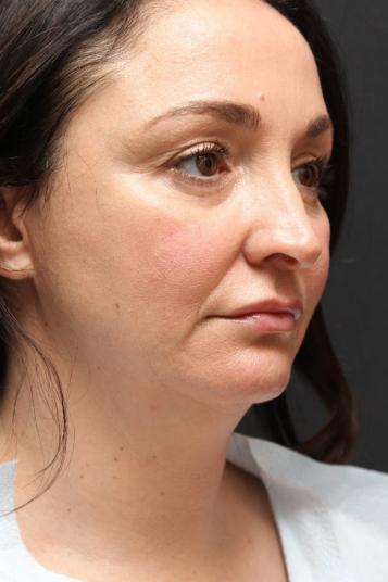 Face and Neck Rejuvenation Case 6753, Before Treatment, Female Patient, Set 3