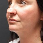 Face and Neck Rejuvenation Case 6753, After Treatment, Female Patient, Thumbnail 4