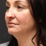 Face and Neck Rejuvenation Case 6753, Before Treatment, Female Patient, Thumbnail 4