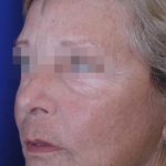 Face and Neck Rejuvenation Case 6490, After Treatment, Female Patient, Thumbnail 1