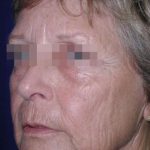 Face and Neck Rejuvenation Case 6490, Before Treatment, Female Patient, Thumbnail 1