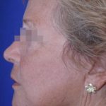 Face and Neck Rejuvenation Case 6490, After Treatment, Female Patient, Thumbnail 2