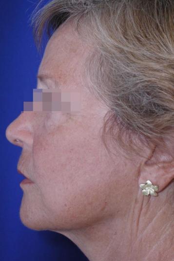 Face and Neck Rejuvenation Case 6490, After Treatment, Female Patient, Set 2