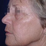 Face and Neck Rejuvenation Case 6490, Before Treatment, Female Patient, Thumbnail 2