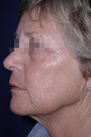 Face and Neck Rejuvenation Case 6490, Before Treatment, Female Patient, Set 2