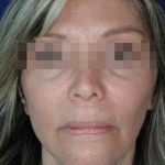 Face and Neck Rejuvenation Case 6505, After Treatment, Female Patient, Thumbnail 1