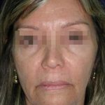 Face and Neck Rejuvenation Case 6505, Before Treatment, Female Patient, Thumbnail 1