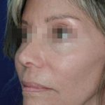 Face and Neck Rejuvenation Case 6505, After Treatment, Female Patient, Thumbnail 2