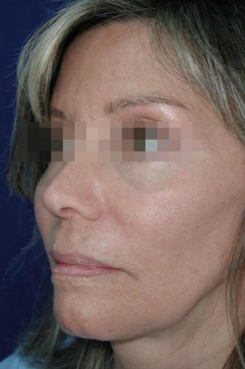 Face and Neck Rejuvenation Case 6505, After Treatment, Female Patient, Set 2