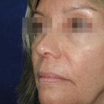 Face and Neck Rejuvenation Case 6505, Before Treatment, Female Patient, Thumbnail 2