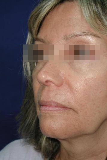 Face and Neck Rejuvenation Case 6505, Before Treatment, Female Patient, Set 2