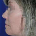Face and Neck Rejuvenation Case 6505, After Treatment, Female Patient, Thumbnail 3