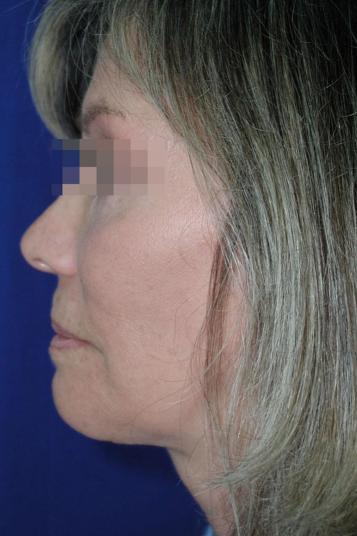 Face and Neck Rejuvenation Case 6505, After Treatment, Female Patient, Set 3