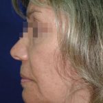 Face and Neck Rejuvenation Case 6505, Before Treatment, Female Patient, Thumbnail 3