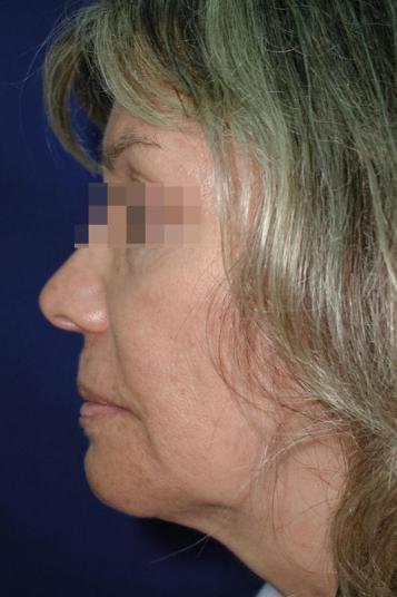 Face and Neck Rejuvenation Case 6505, Before Treatment, Female Patient, Set 3
