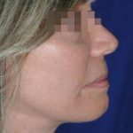 Face and Neck Rejuvenation Case 6505, After Treatment, Female Patient, Thumbnail 4